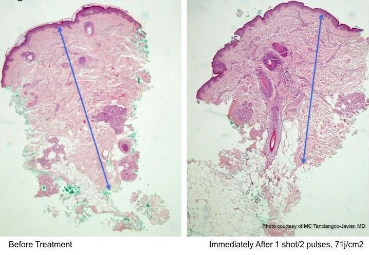 [IntraGen] The clinical and histological effects of a new 6MHz Monopolar RF Device for facial skin tightening (by Dr Ma Christina Tanciangco-Javier)