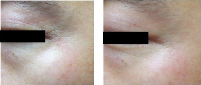 before and after - Intragen RF wrinkle removal device