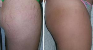 Stretchmark intracel - Intracel RF microneedle wrinkle removal device