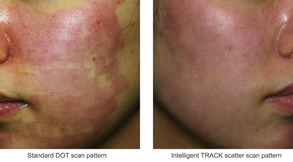 scan pattern comparison Edge fractional laser for wrinkle removal and skin rejuvenation